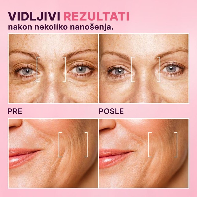 BOTOX---PRIJE-POSLIJE-srb
